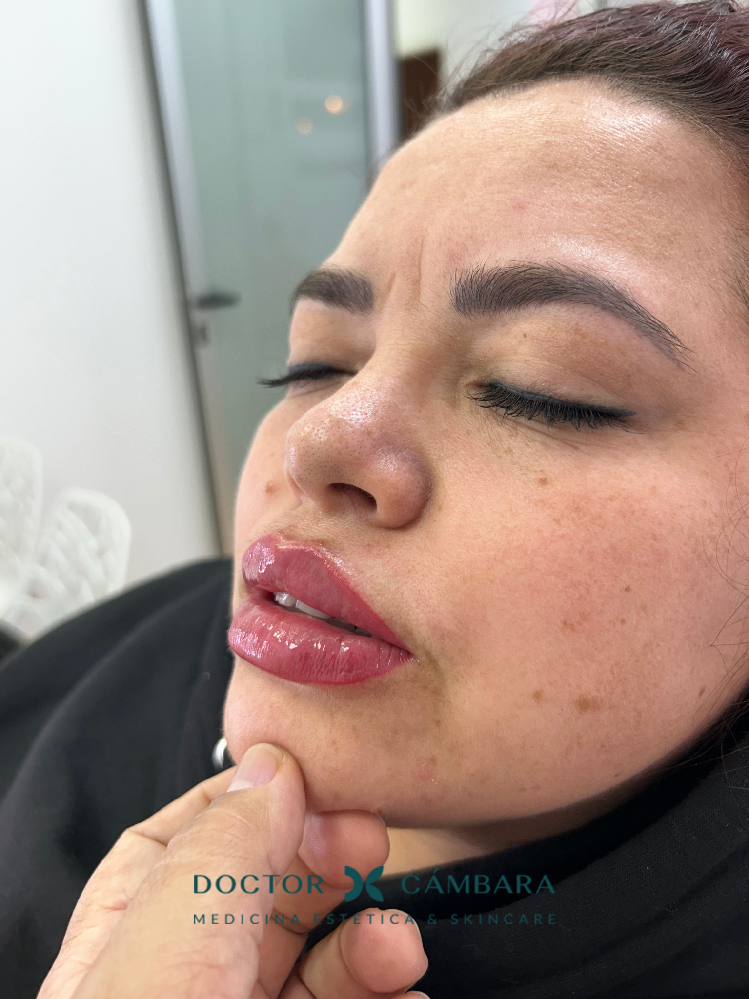 Aumento de labios en Murcia: foto después del tratamiento