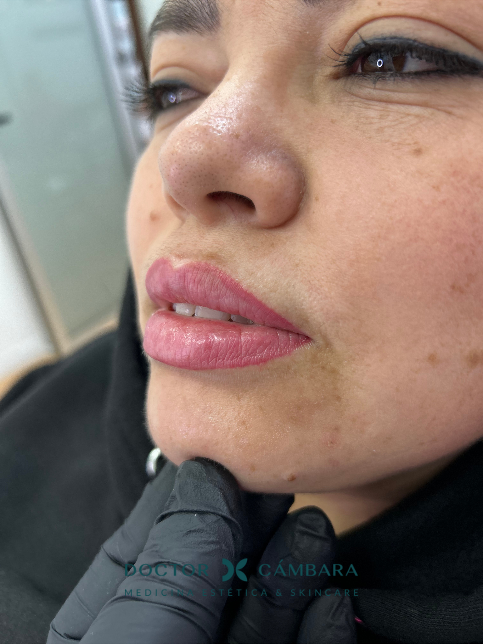Aumento de labios en Murcia: foto antes del tratamiento