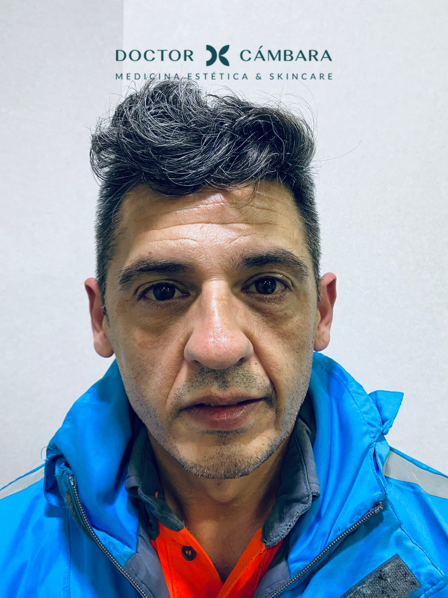 Armonización facial en Murcia: foto antes del tratamiento