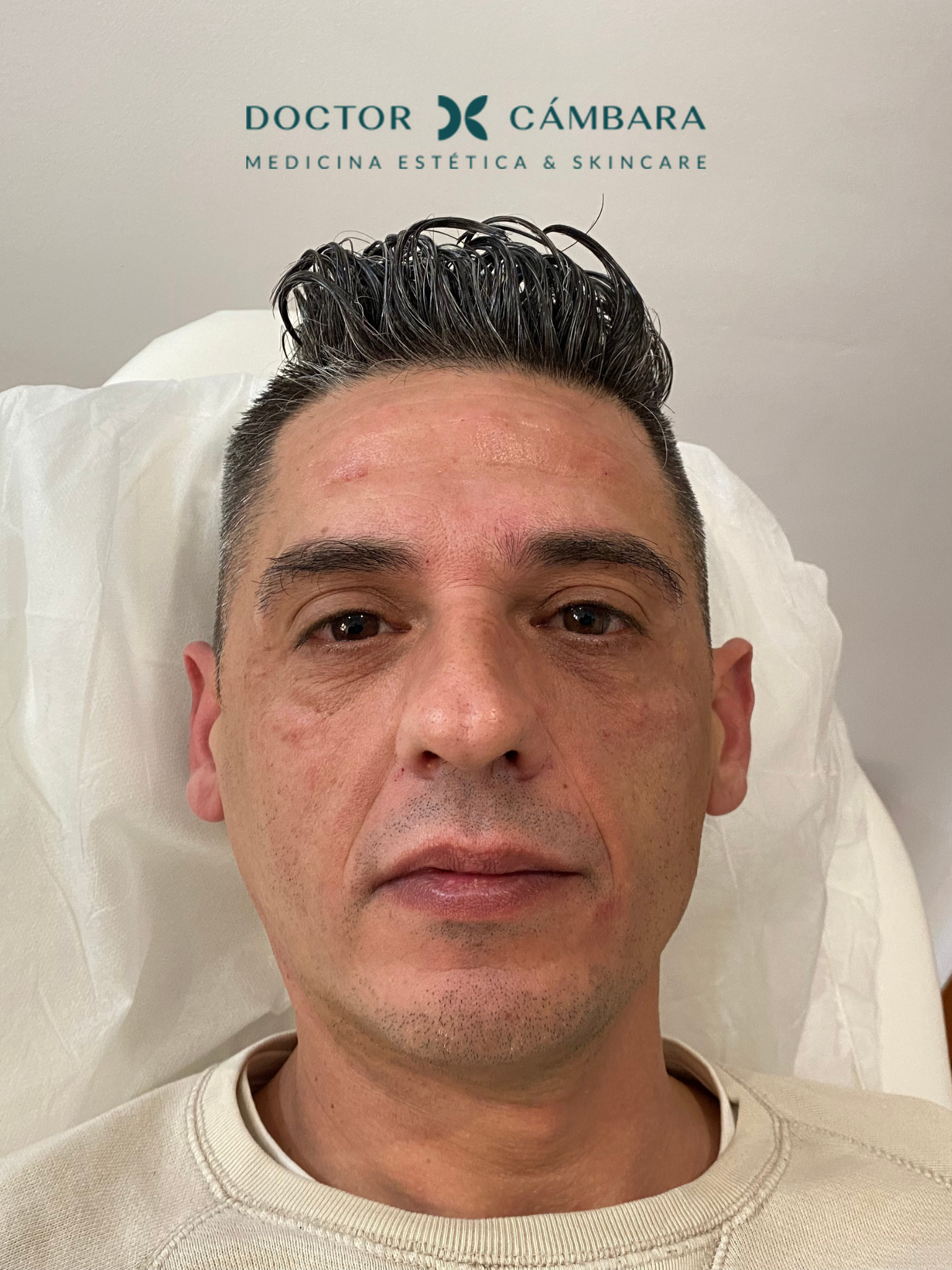 Armonización facial en Murcia: foto después del tratamiento