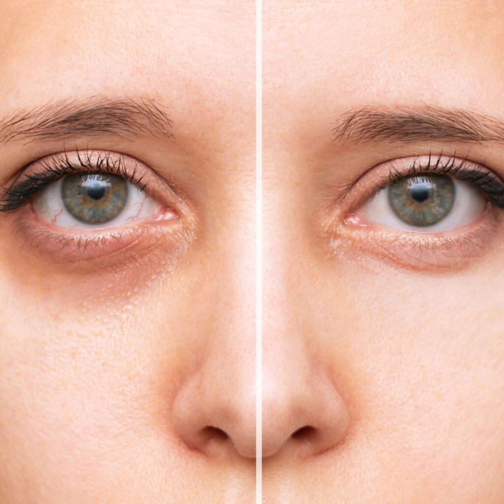 Ojeras